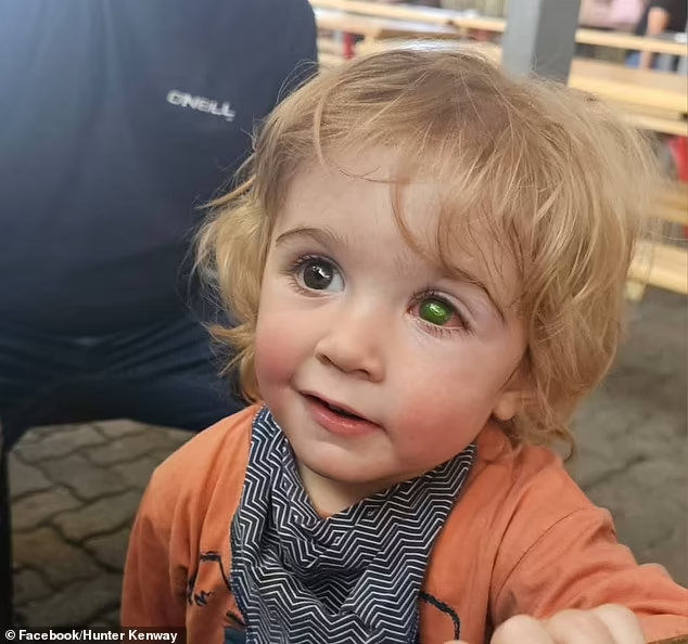 Toddler faces losing his eye after being kissed by someone with a cold sore