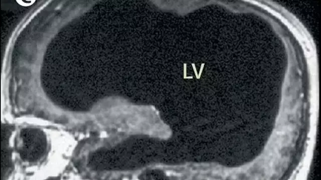 Man discovers he’s been living with ‘half a brain’ after suffering from common symptom