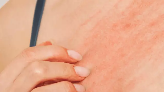 Doctor issues severe warning after ‘medieval’ disease sweeping UK keeps getting misdiagnosed