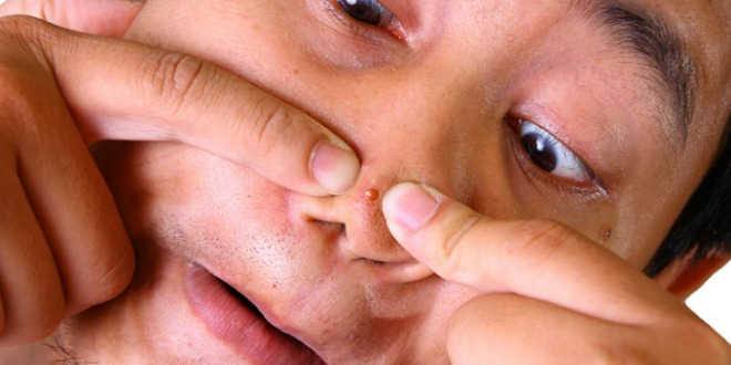 The Hidden Causes of Acne You Should Know