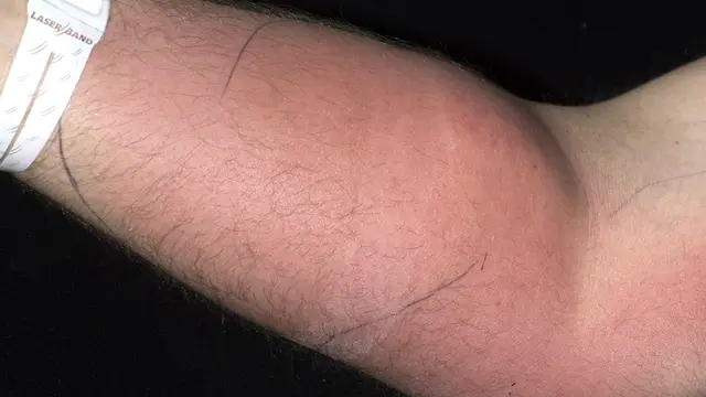 Man suffered horrifying side effects after injecting himself with own sperm to ‘cure back pain’