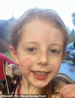 ‘Britain’s most dangerous spider’ strikes in Hampshire: Girl, 5, is left unable to walk and covered in rashes after a bite from a noble false widow