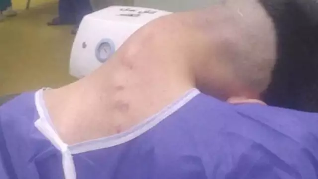 Man, 23, develops rare condition called ‘dropped head syndrome’ after battling addiction for years