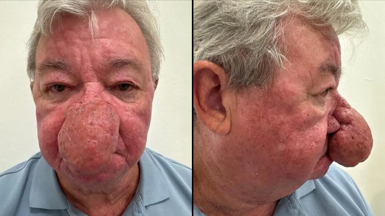 Man Unable To Kiss Wife In One Of ‘Worst Cases’ Of Nose Growth Ever