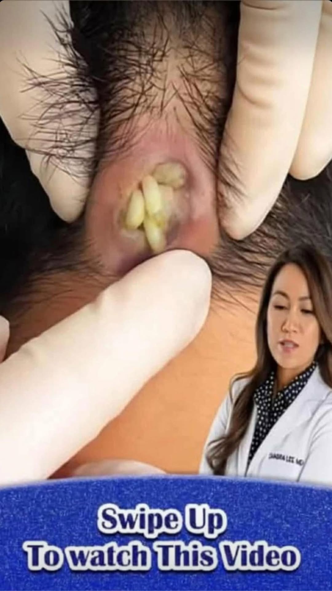 Their acne is severe