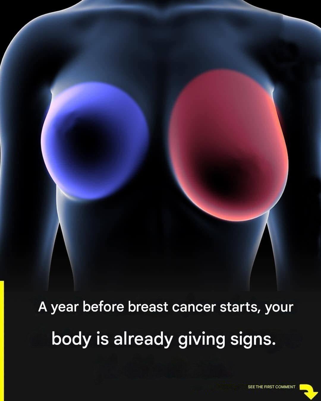 Breast cancer: 4 early signs every woman should know.